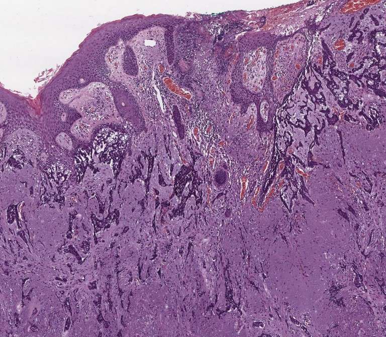 Qué es el carcinoma basocelular y por qué debes conocerlo Clínica Dermatológica Novaderma